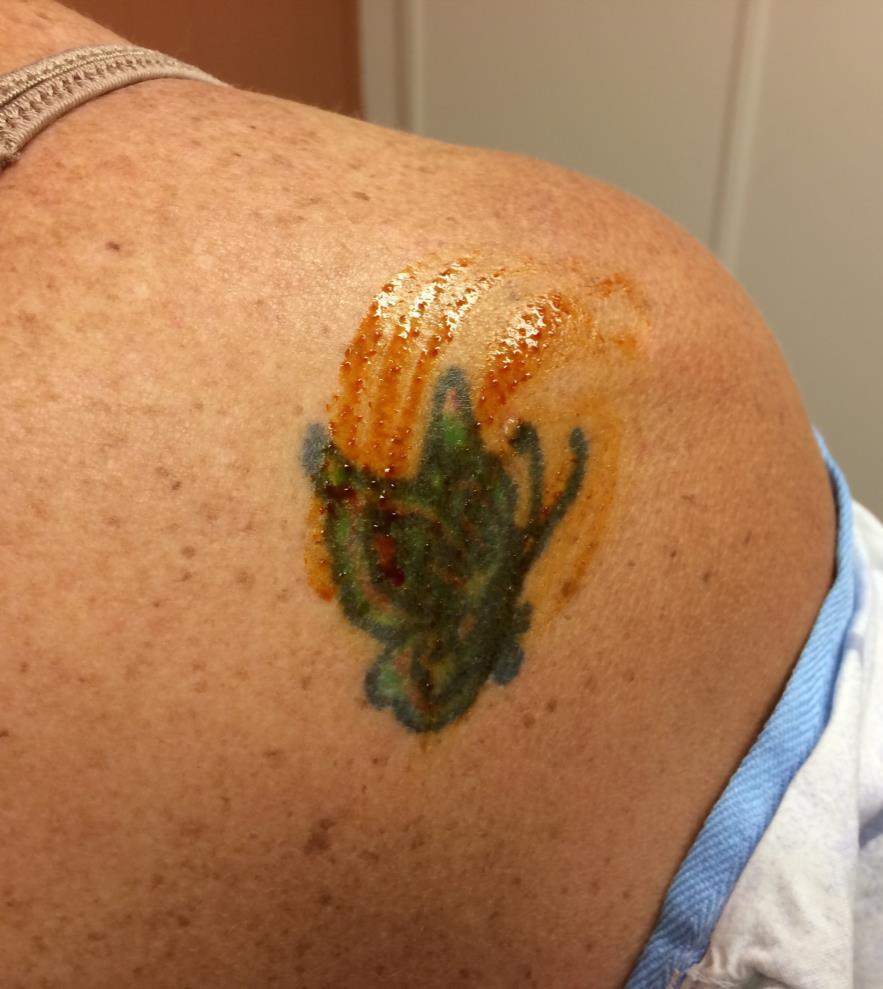 Injection Danger Areas Skin tattoos Cellulitis Folliculitis Psoriasis/Eczema