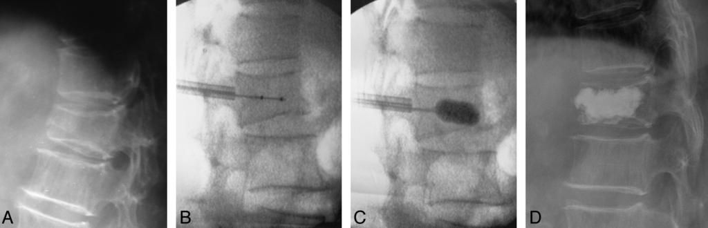 FIG 4. X-ray films of a typical patient: 69-year-old woman with a T12 vertebral compression fracture (wedge type). A, Preoperative standing lateral, HA, HM, KA, and Cobb were 20.20 mm, 24.57 mm, 17.