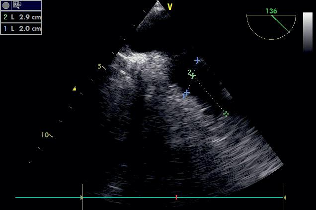 Case report 65-year-old woman, with permanent non-valvu - lar F, previous ischemic stroke on warfarin therapy, medicated hypertension, diabetes mellitus, chronic heart failure with preserved left