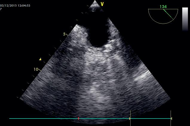 6 cm) on the atrial side of the Watchman TM device 6 months after implantation. Transesophageal echocardiography: midesophageal views (3 100 degrees; 3 90 degrees) (2.0 3.0).