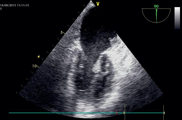 Transesophageal echocardiography: mid-esophageal views at 90 degrees (4 and 4) antiplatelet and antithrombotic regimen comprises: aspirin 100 mg q.s. started before the intervention, an intravenous infusion of heparin during the procedure, followed by short-term O with warfarin (for 45 days) and long-term DPT (for 6 months) [1].