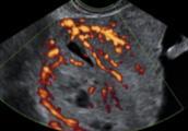 Understanding the IOTA (International Ovarian Tumor Analysis) terminology &