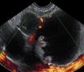 Accuracy of ultrasound in the diagnosis of