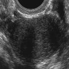 ovarian masses Malignancy Regular echogenicity