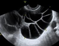 Multilocular cysts with a large number of locules