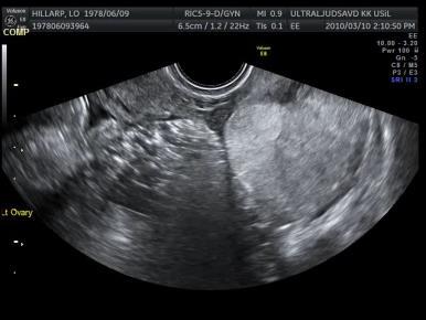 Case example (2) Simple Rules tick box Ultrasound features predictivefor a malignant tumor (M-features) M1 Irregular solid tumor M2 Presence of ascites Features predictive for a benign tumor