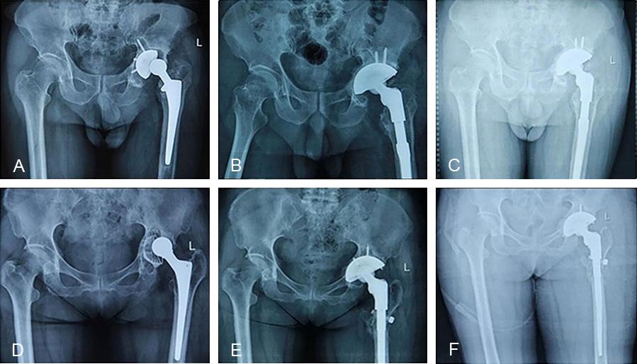 earlier than any obvious functional improvement as shown by the HHSs (which occurred at about 6 months after the surgery). Complications and Implant Survivorship Figure 1.