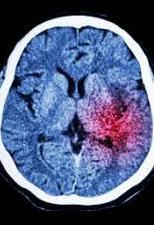 Time is Brain The only way to determine the type of stroke as well as the appropriate course of treatment is emergency brain imaging, interpreted by a neurologist/ neuro-radiologist Many community