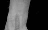 Dermopathy in scar