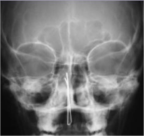 Kuvamine: Röntgen Oktsipitomentaalne ülesvõte (Waters, nina-lõuaots): näeb kõiki ninakõrvalkoopaid, eriti hästi maksillaarsiinuseid.