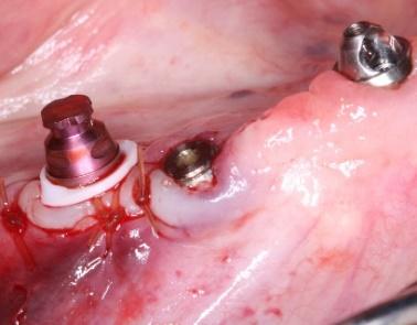 the PMMA prosthesis and let the implant fully integrate.