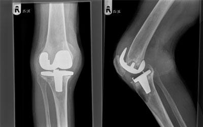 X ray findings in post op infection of TKR It is hard to identify infection in early stages on