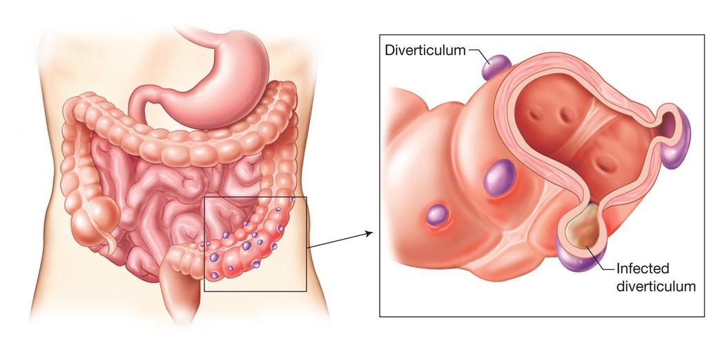 FIGURE 30-10 Colon with diverticulosis.