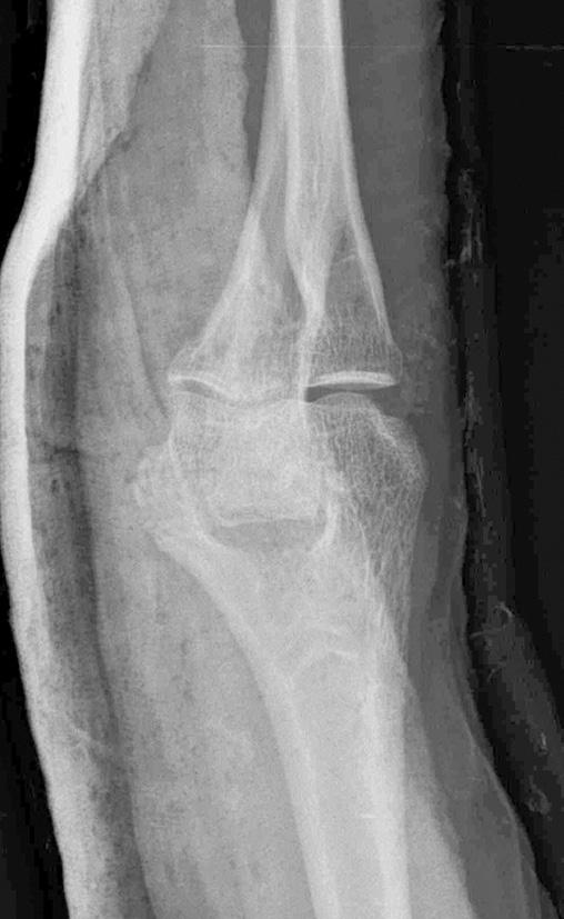 67 Heterotopic Ossification after Medial Epicondylectomy plained of persistent pain at the medial aspect of the elbow and a tingling sense of her small finger.