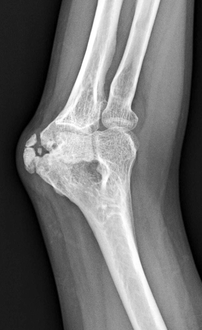 Beginning from the medial supracondylar ridge, the posterior and anterior muscles were elevated, exposing the heterotopic bone.