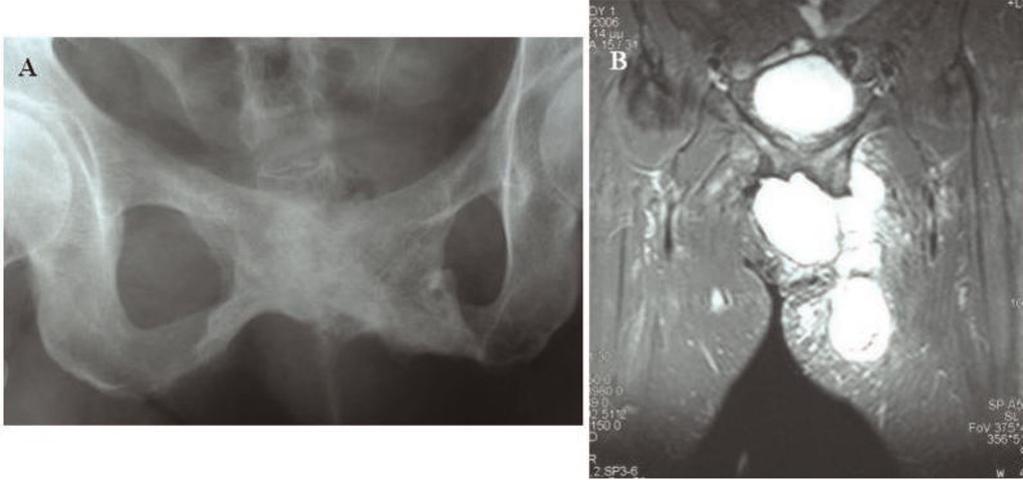 Figure 2. Preoperative plain X-ray (A) and MRI imaging of the tumor (B). The fact that in our case there was a tumor recurrence twice following partial removal supports the above findings.