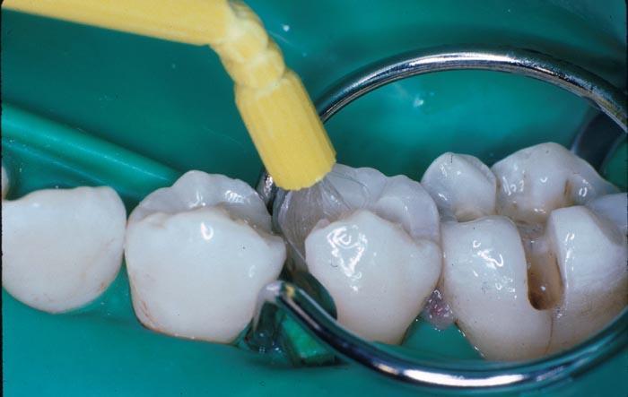 Ideal restorative material Why knowing biomaterials is important Dentistry is filled with