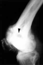 osteolytic lesion (arrow-head) in lateral femoral condyle, and later MRI confirm this osteolytic lesion to be a focal fatty replacement or fatty bone marrow; it should not be mistaken as neoplasm.
