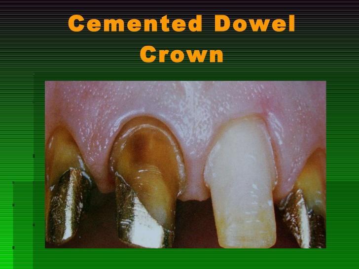 Dowel crown Full crown cover with