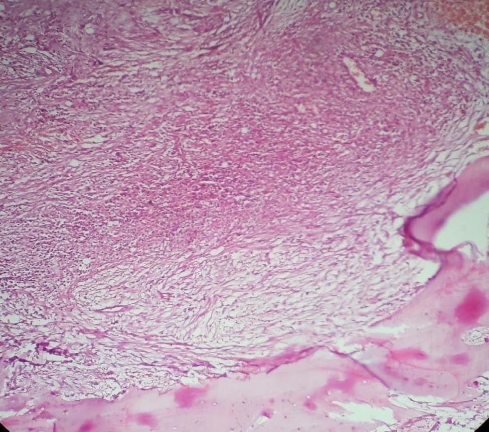 Figure 2: Viable and bony tissue along with chronic non