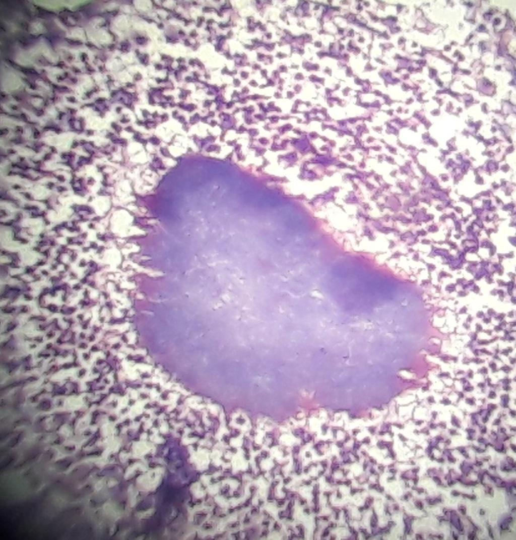 Figure 3: Actinomycotic colony with chronic non