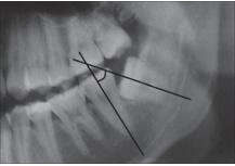 Prevalence of third molar impaction in patient with mandibular anterior teeth crowding (Tan Chun Wei, et al.