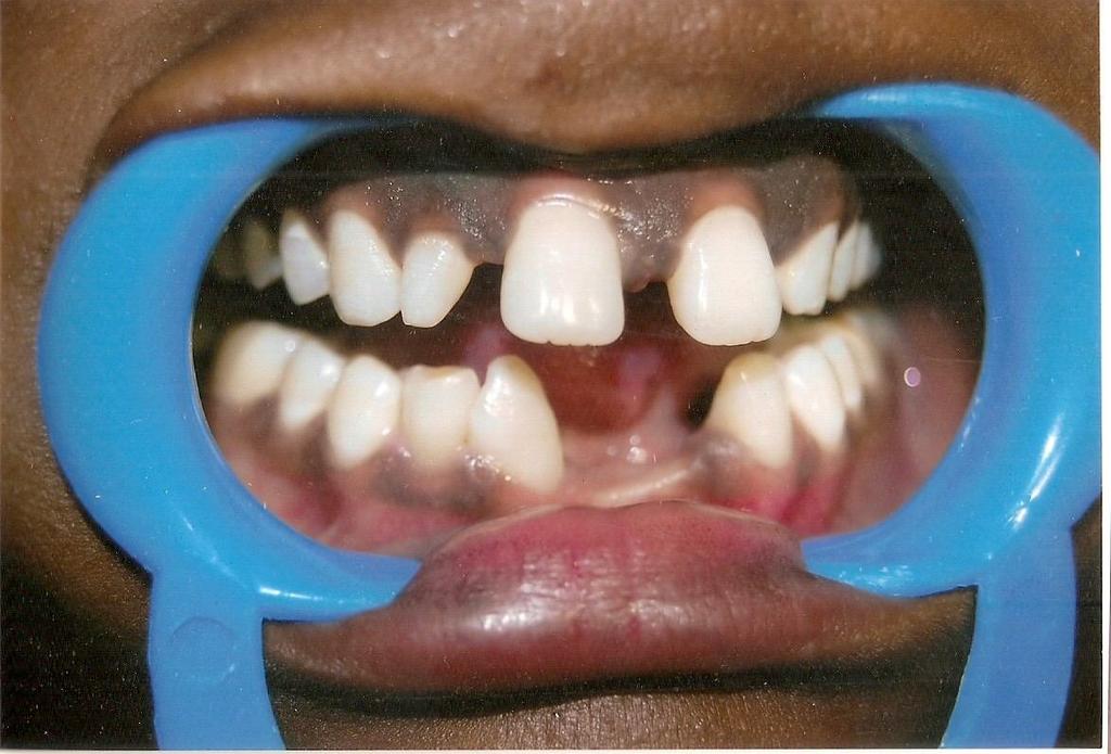 medical and dental history which were both noncontributory. The initial examination performed, revealed asymptomatic maxillary midline supernumerary teeth.
