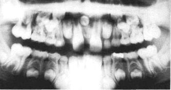of this rule indicated a mesiodens, at least partially, positioned labially to the roots of the permanent central incisors.