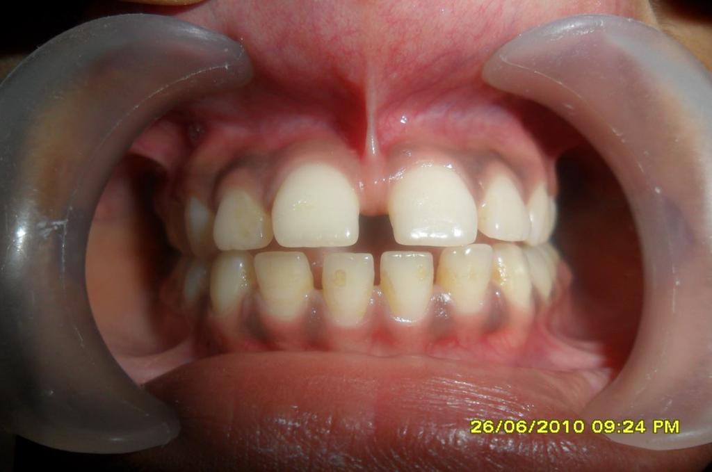 Root development appeared normal with the mesiodens primarily affecting tooth position. Figure-4: OPG of the child showing the presence of mesiodens between the two central incisors.