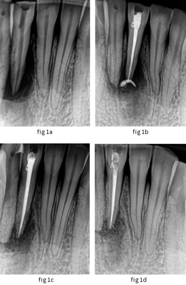 Case- I A 29-year-old female patient reported to the Department of Conservative Dentistry and Endodontics with the chief complaint of intermittent pain and swelling in lower right front tooth region