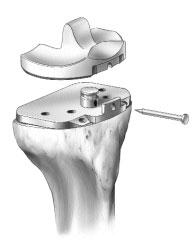 PATELLAR PREPARATION Note: If the surgeon determines that the condition of the patient s patella is satisfactory, it is not necessary to resurface the patella.
