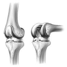 Flex and extend the knee with the provisionals in place (Fig. 18). Fig. 18 Remove the Small-head Holding Pin, the Articular Surface Provisional, and the Femoral Provisional.