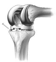 Fig. 20 If the Articular Surface Provisional lifts off anteriorly during flexion, check the resected bone surface and remove any bony protrusions.