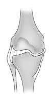 VARUS RELEASE To correct most fixed varus deformities (Fig. 5), progressively release the tight medial structures until they reach the length of the lateral supporting structures.