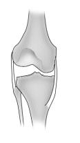 To facilitate the release, excise osteophytes from the medial femur and tibia.