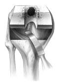 and allows precise positioning of the femoral component. The anteroposterior axis of the femur provides an additional rotational landmark.