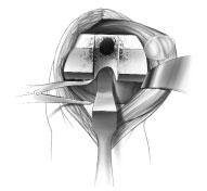 Avoid positioning the component where it overhangs the bone as this may restrict flexion. With the knee in flexion, remove posterior osteophytes with a 3/4-inch curve-on-flat osteotome (Fig. 7).