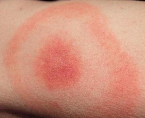 Acute Lyme Infection 1/3 have characteristic erythema migrans, the bull s eye rash at the site of the tick bite within 3-30 days.