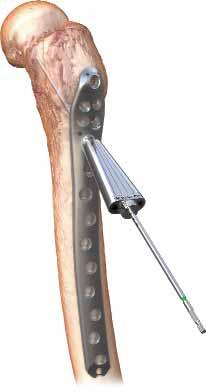 In the lateral view, verify the correct femoral neck anteversion and 3.2mm Guide Pin placement.