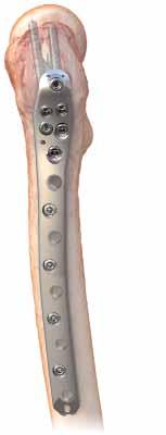 5mm Proximal Femur Locking Plate is precontoured to fit the anatomy of the lateral aspect of the greater trochanter.