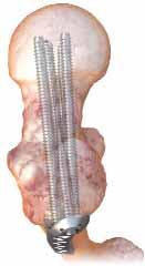 This anterior curve provides an anatomic plate fit to ensure optimal plate position on bone.