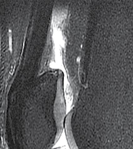 A partial thickness graft will be taken if the tendon is over 7 mm thick.