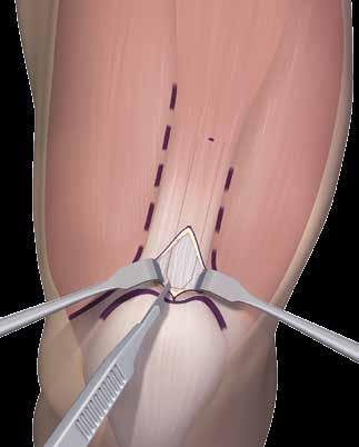 Connect the cuts transversely on top of the patella.