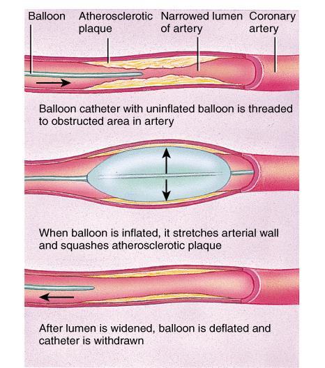 Balloon Angioplasty A catheter and baloon are threaded into the coronary artery to the point of