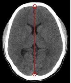 cerebral artery Basal ganglia
