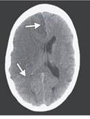 cerebral artery (MCA) Basal