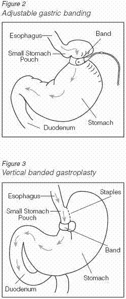 Adjustable gastric banding.