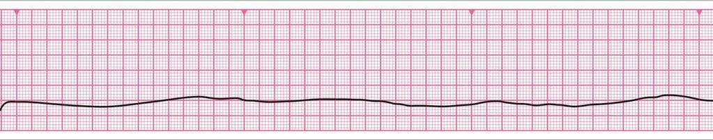 Non-Shockable (Asystole) Absent ventricular (QRS) activity Atrial activity (P
