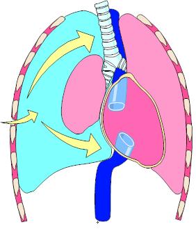 Tension pneumothorax Check tube position if intubated Clinical signs Decreased breath sounds