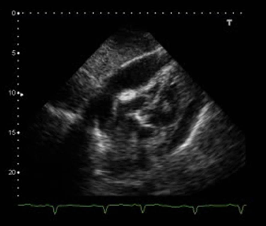 Tamponade, cardiac Difficult to diagnose without echocardiography Consider if penetrating chest
